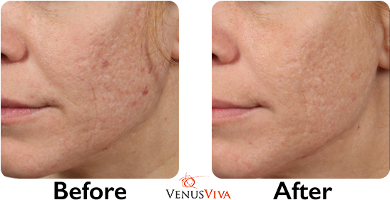 Before & After - Venus Viva 2018 Before And After (590x310), Png Download