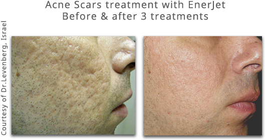 Click Here To Read More About - Enerjet Before And After (700x322), Png Download