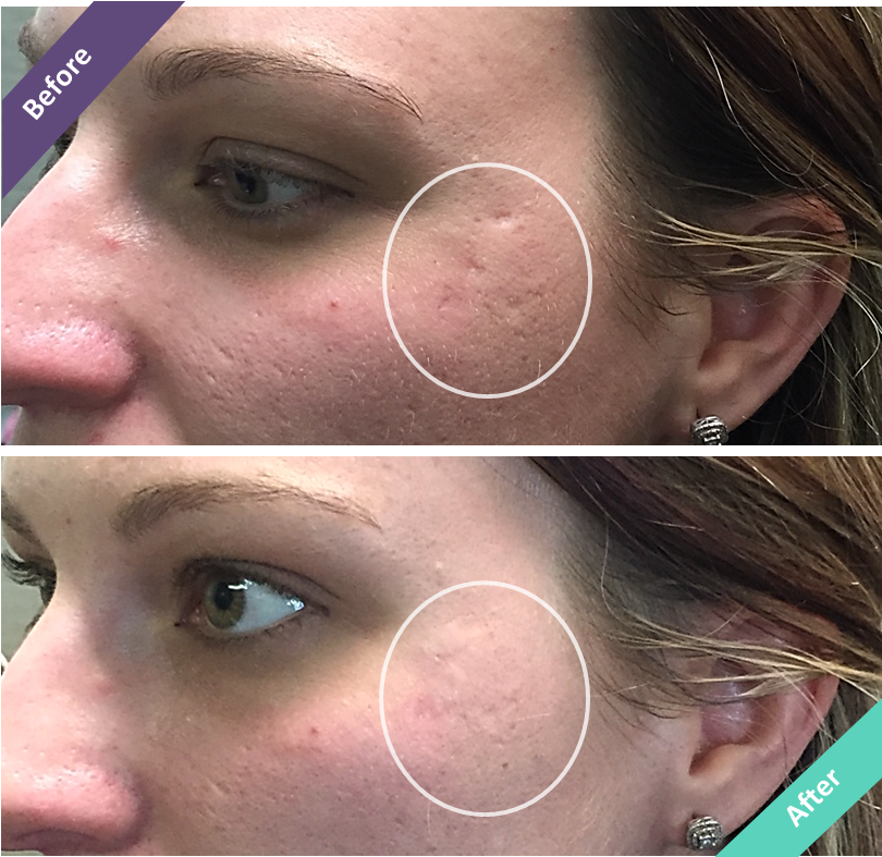 The First Acne Concealer That Fills In Ice Pick, Rolling - Ice Pick Scar Removal (881x853), Png Download