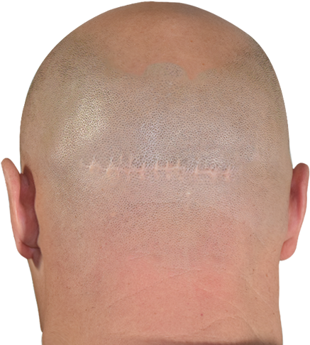 Scars Hairloss - Buzz Cut (579x500), Png Download