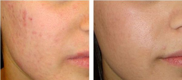 With A Laser, Scars Can Be Lessened Significantly And - Scar (600x480), Png Download