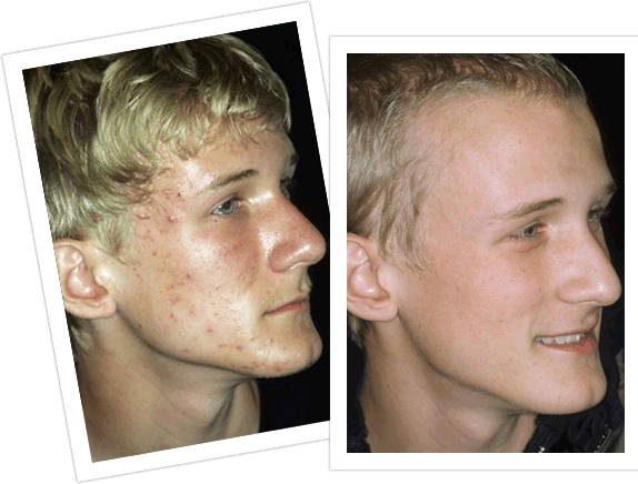 Teenage Acne Before And After Laser Acne Treatment - Acne Scars On Teens (574x436), Png Download