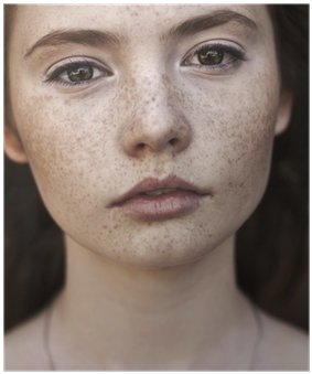 Portrait Of A Beautiful Brunette With Freckles Poster - Black Spots In Face (400x400), Png Download