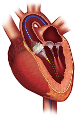 The Patient's Aortic Valve Is Replaced Using A Minimally-invasive - Tavr Medical (309x400), Png Download