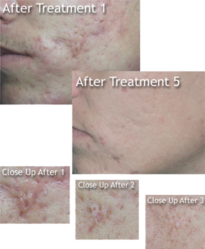 Are You Tired Of Trying Expensive And In Effective - Dermaplaning On Acne Scars (410x498), Png Download