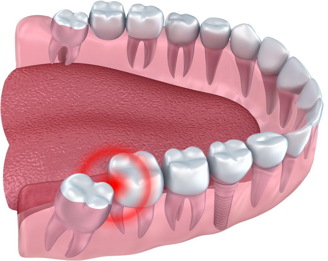 Drawing Of A Set Of Teeth With One Tooth Emerging Into - Wisdom Teeth (1200x1200), Png Download