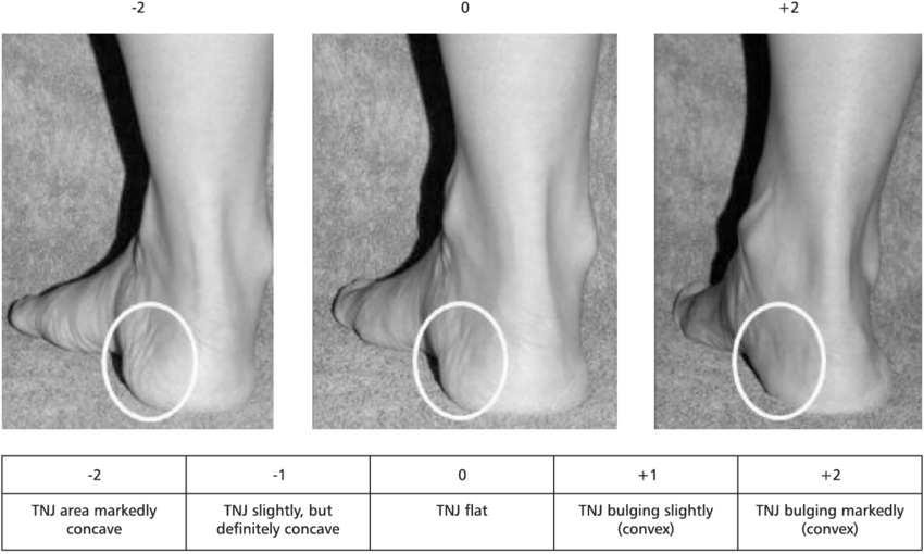 The Evaluation Of Bulging In The Region Of The Talonavicular - Talonavicular Joint (850x510), Png Download