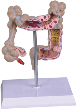 Human Diseased Large Intestines Model For Education - Carousel (350x350), Png Download