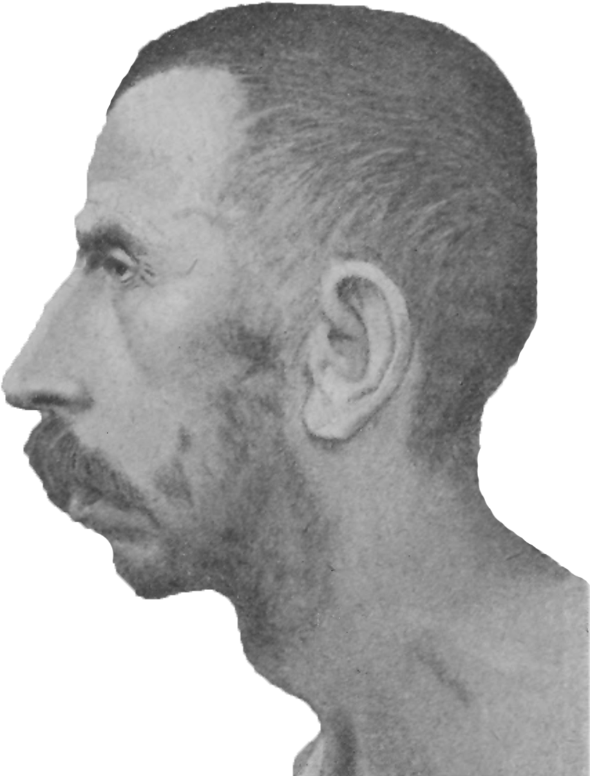 Schizophrenia Congenital Idiot, Age - Face Profile Png (877x1143), Png Download