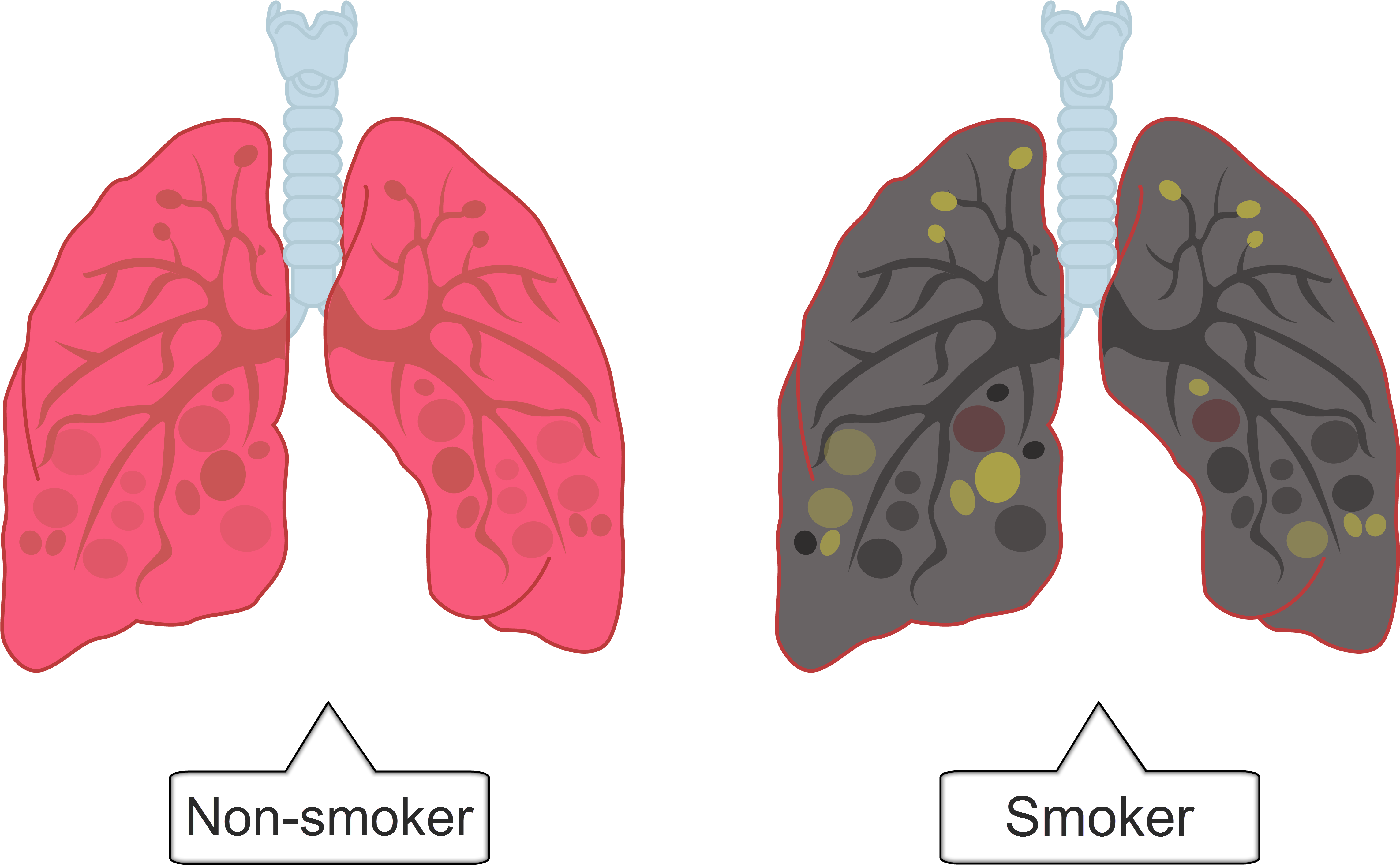 In The Lungs, The Cells That Line The Bronchi Produce - Lungs Of A Smoker Png (5125x3147), Png Download