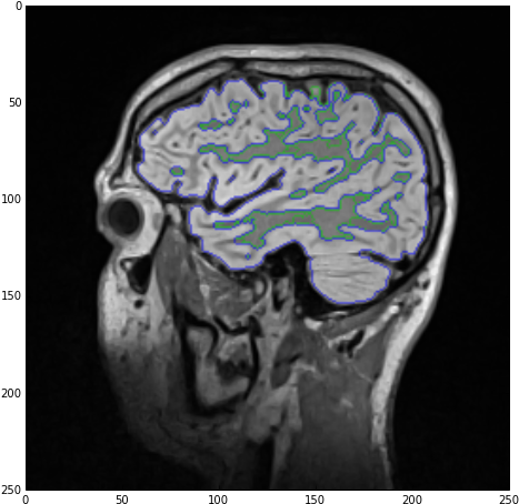 Label Overlay Showing Both White And Gray Matter As - Grey Matter (480x468), Png Download