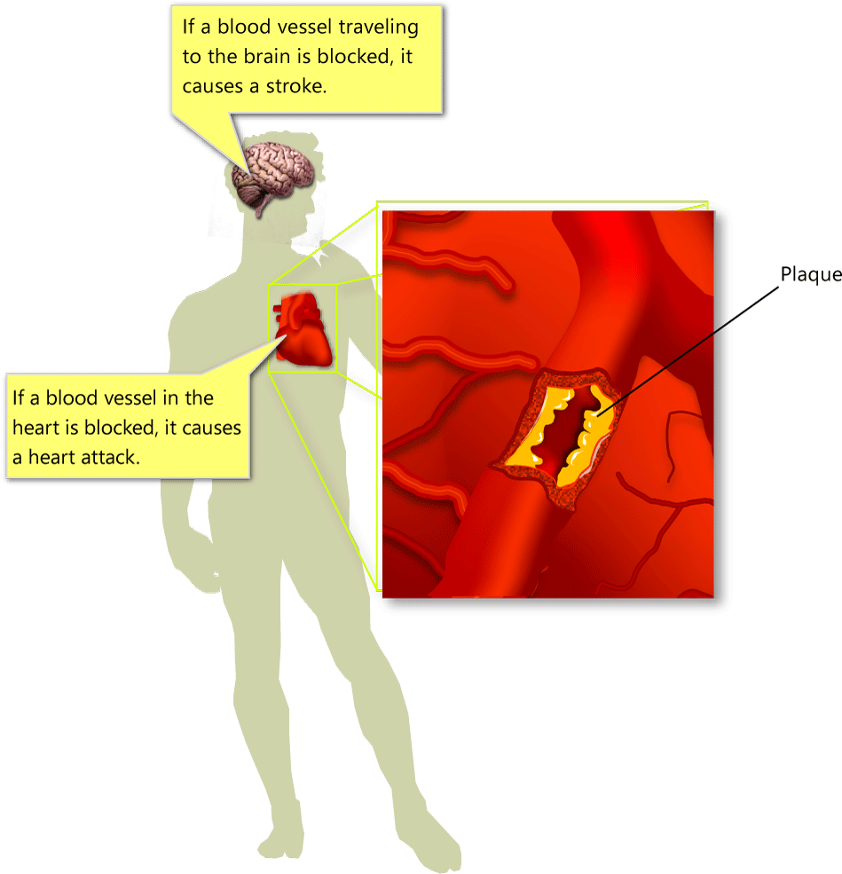 Atherosclerosis - Heart Wall Block (976x1043), Png Download