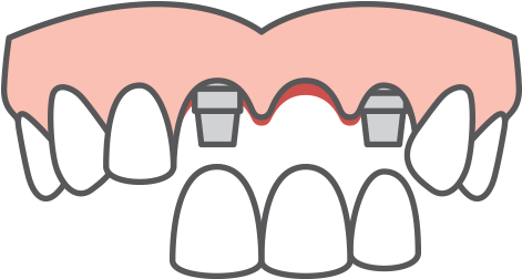 Multiple-tooth Dental Implants Icon - Denture Icon Png (470x313), Png Download