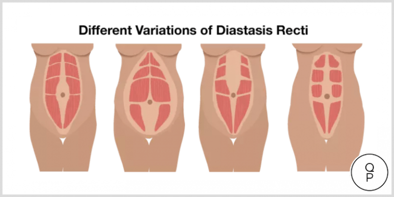 Q Pilates Dra Rectus Diastasis - Muscles Do Sit Ups Work (768x384), Png Download
