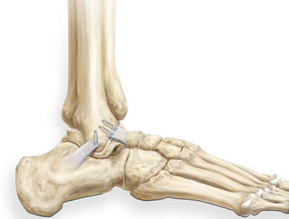 The Divided Ligament Is Then Re-attached To Bone With - Ankle Bone Png (420x318), Png Download