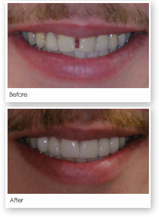 A Dental Bridge Is Custom Made False Tooth Or Teeth - Lieberman Larry T Dds Pa (316x431), Png Download