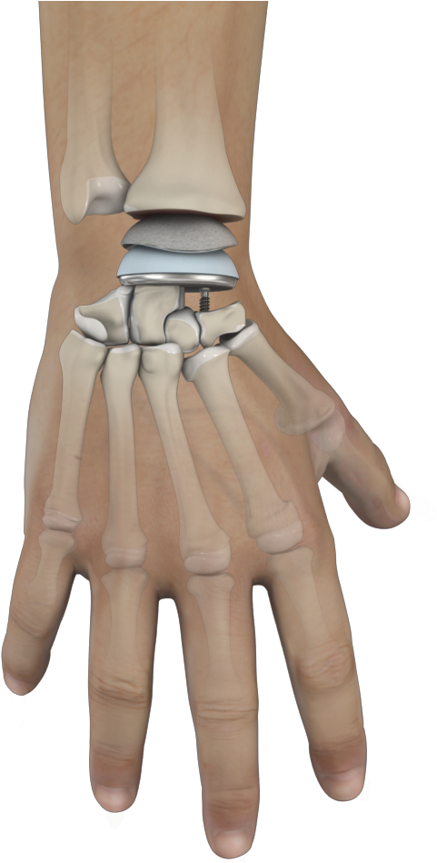 Wrist Joint Replacement - Joint Replacement (1500x999), Png Download
