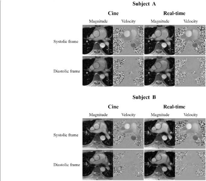 Comparisons Of Real-time Flow Imaging With Cine Flow - Medical Imaging (850x599), Png Download