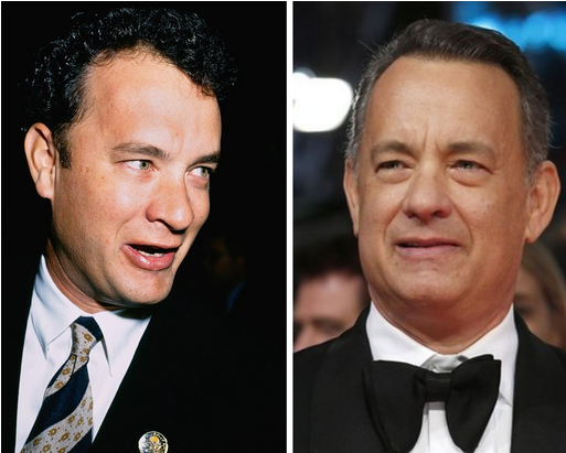 Tom Hanks, 1995 Vs - Tom Hanks Before Hair Transplant (810x410), Png Download