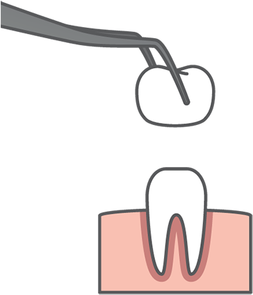 Crown - Auburn Hills Family Dentistry (500x460), Png Download