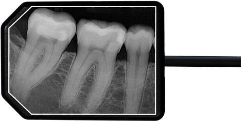 Apex Dental Sensor X Rayapex Dental Sensor X Ray - Dental X Ray Sensors (500x256), Png Download