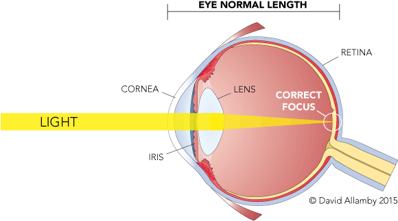 Myopia, The Medical Term For Near-sightedness, Is Most - Light Passes Through The Cornea (600x343), Png Download