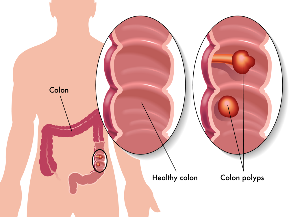Colon - Imagenes Del Cancer De Colon (1000x753), Png Download