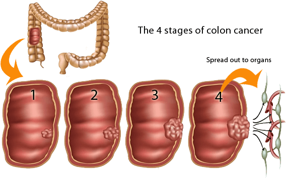 Surgery For Colon Cancer In Men - Cancer Colorectal (600x358), Png Download