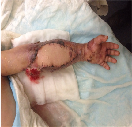 Case 3 Immediate Post Op 3 Days, Minimal Debridement - Hand (903x412), Png Download