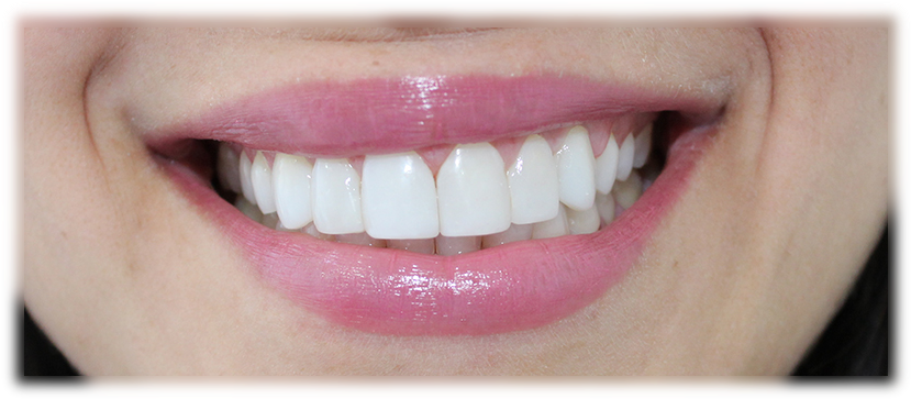 Diseño De Sonrisa - Design (850x384), Png Download