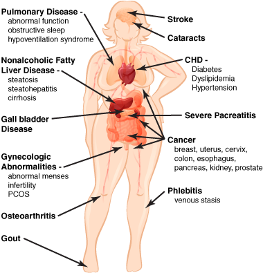 Medical Complications Obesity - Diagram (391x413), Png Download