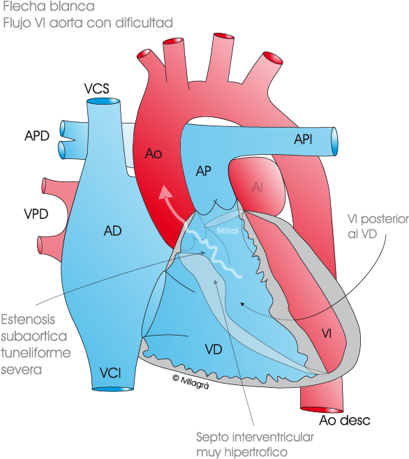 La Estenosis Subaórtica Fibromuscular - Stenosis (610x670), Png Download