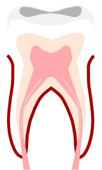 Without Endodontic Treatment The Only Other Alternative - Dental Implant (500x626), Png Download