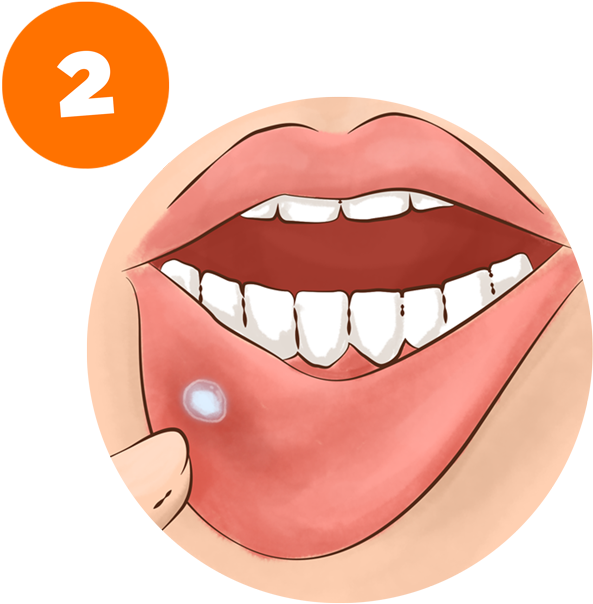 Allow It To Remain On The Area For As Long As Possible - Daktarin Oral Gel Use (600x683), Png Download