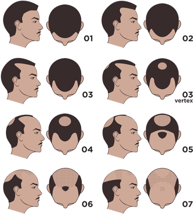 The Only 2 Fda-approved Medications To Combat Hair - Combating Male Pattern Baldness (517x440), Png Download