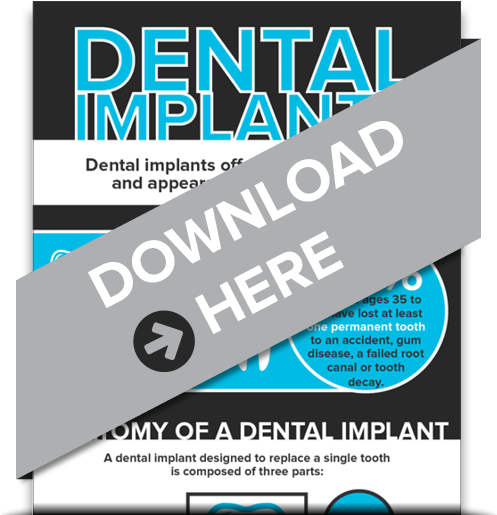 Download Our Free Informative Infographic About Implants - Lonzame Dental Care (500x540), Png Download