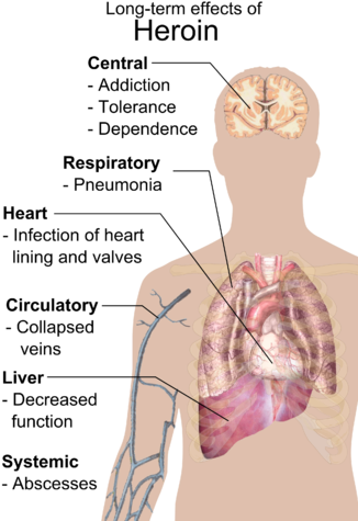 166 × 240 Pixels - Long Term Effects Of Heroin (332x479), Png Download