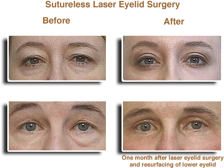 Laser Eyelid Surgery Before & Afters - Eye Laser Surgery Before And After (566x405), Png Download
