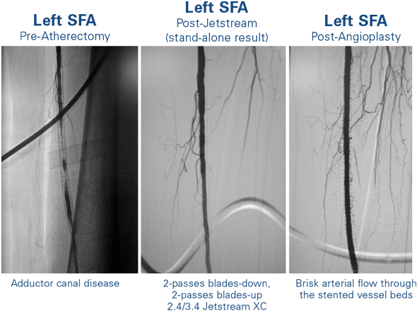Jetstream Atherectomy Treatment Of A Long, Diffuse - Sfa In Stent Restenosis (600x474), Png Download