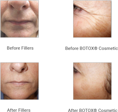 Did You Know An Ophthalmologist Discovered Botox For - Romanoff Vision (415x403), Png Download