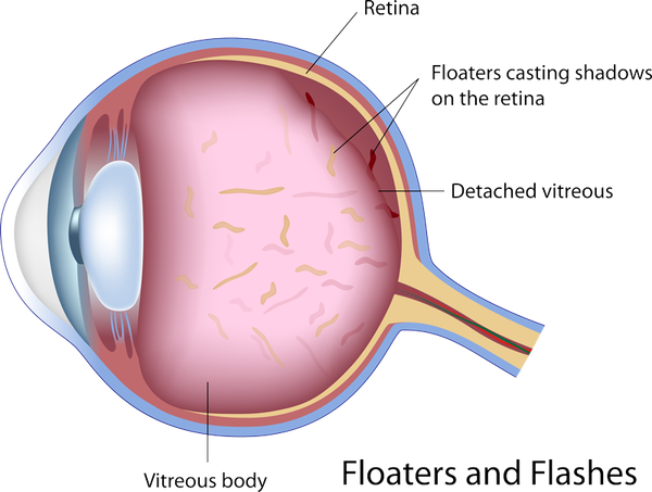Typically, The Flashes Will Subside After A Few Weeks, - Eye Floaters And Flashes (600x453), Png Download