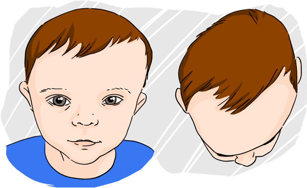 Plagiocephaly - One Side Of Face Is Flat (600x420), Png Download