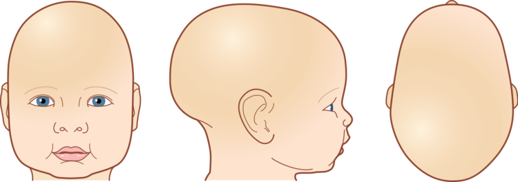 Scaphocephaly-example - Long Back Of Head (750x264), Png Download