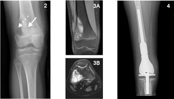 An Mri Scan Better Delineated A Lesion In The Distal - Femur (780x375), Png Download
