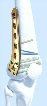 Tomofix Lateral Distal Femur Plate With Screws In Bone - Femur (516x373), Png Download