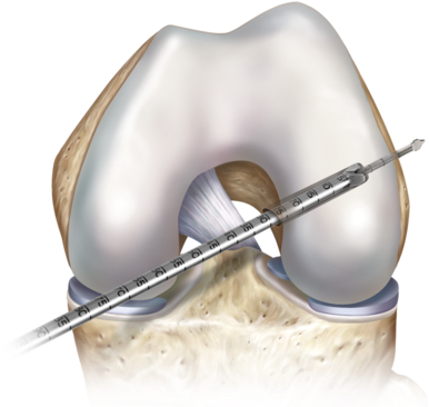 Medial Portal Femoral Socket Preparation 0 Large - Transportal Technique Acl (400x370), Png Download