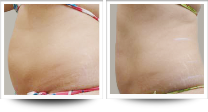 Skin Tightening After 4 Treatments - Medicine (967x461), Png Download