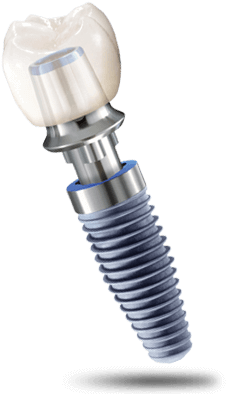 Dental Implant Geelong Dentist Dr Stolz - Dental Implant (400x400), Png Download