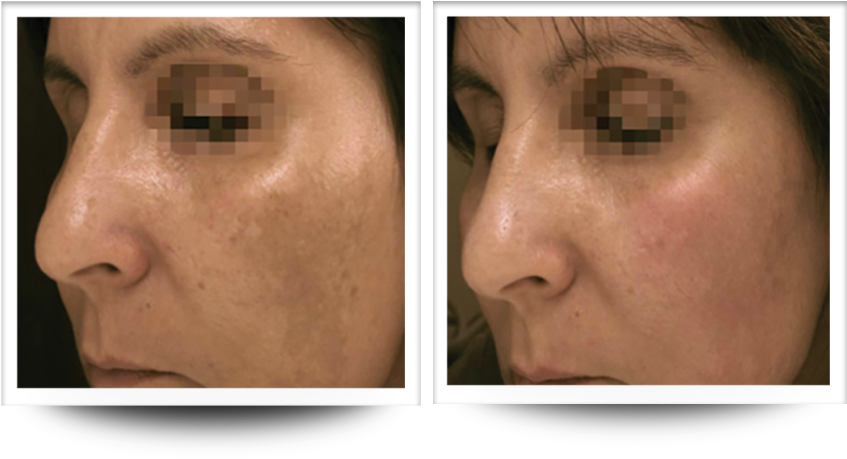 Skin Resurfacing/rejuvenation Courtesy Of Dr - Accent Prime Before And After (967x461), Png Download