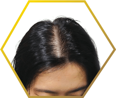 Female Pattern Baldness - Hair Loss (450x380), Png Download
